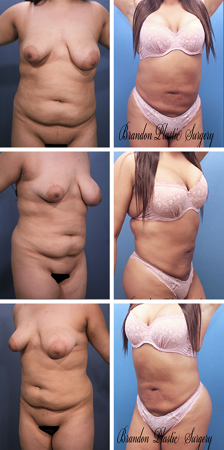 26 y/o Body Makeover Hillsborough County Fl Liposuction with Natural fat transfer Brazilian Butt Lift and breast enhancement .