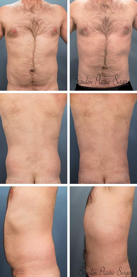 43 y/o Male Liposuction Lake Wales Fl.l gynecomastia with removal of love handles Abdominal fat is very difficult to diet away even for lean and physically active men.
