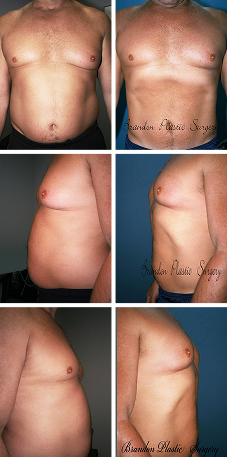 51 y/o Male Liposuction Lakewood Ranch FL Vaser Ultrasonic high definition technique to lipo sculpt stubborn belly fat down to the abdominal musculature .