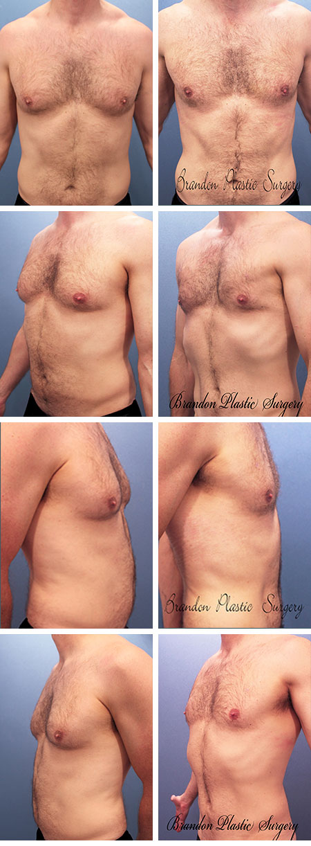 29 y/o Male Liposuction Apollo Beach Sun City FL Gynecomastia Vaser Lipo sculpting to highlight the underlying abdominus recti and serratus muscles.