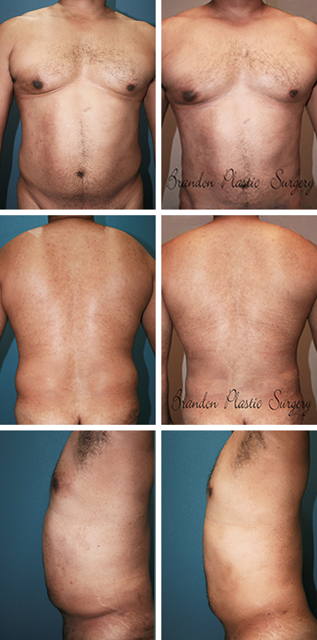 52 y/o Male Liposuction Auburndale Florida Gynecomastia Vaser ultrasonic assisted fat removal of stubborn abdominal tire and back rolls .