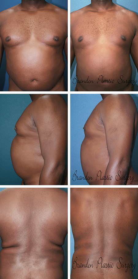 49 y/o Male Liposuction Dade City Zephyrhills Fl. Gynecomastia breast reduction and waist fat and flank roll removal with Vaser lipo sculpting technique