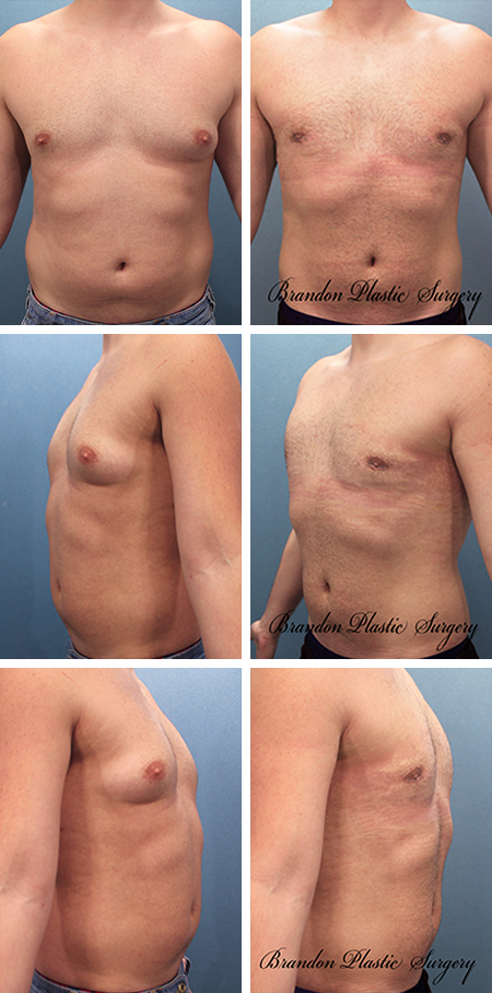 22 y/o Gynecomastia Hernando County Florida Male Breast Reduction and waist contouring with Vaser Lipo sculpting . Note flattening of puffy nipples and sagging excess breast skin .