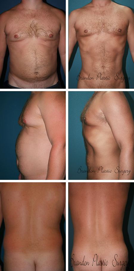 28 y/o Male Liposuction Riverview Florida Breast Reduction Surgery with high definition Vaser ultrasonic technique to accentuate abdominal musculature.