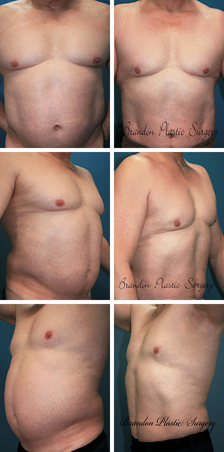 58 y/o Male Liposuction Pasco County Florida Gynecomastia breast reduction with excess belly fat removal and waist Lipo sculpting