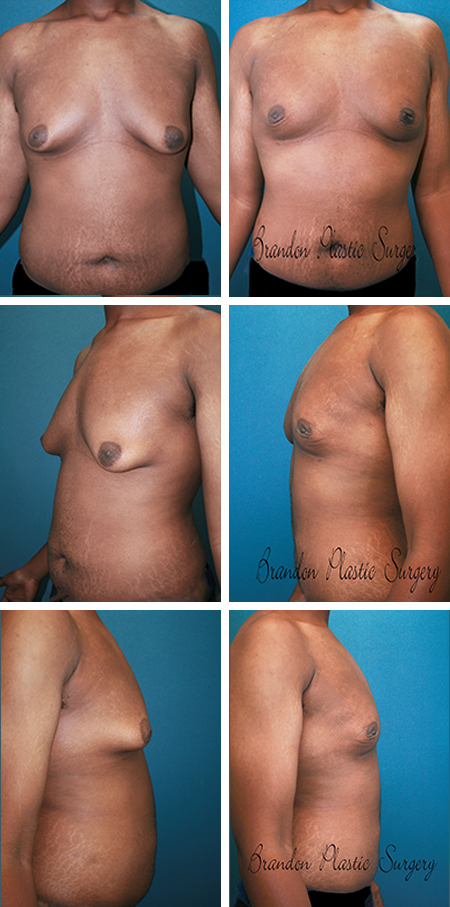 26 y/o Male Breast Reduction Hillsborough County Fl. Gynecomastia removal and excess hanging breast skin tightening with scar less Vaser ultrasonic technique .