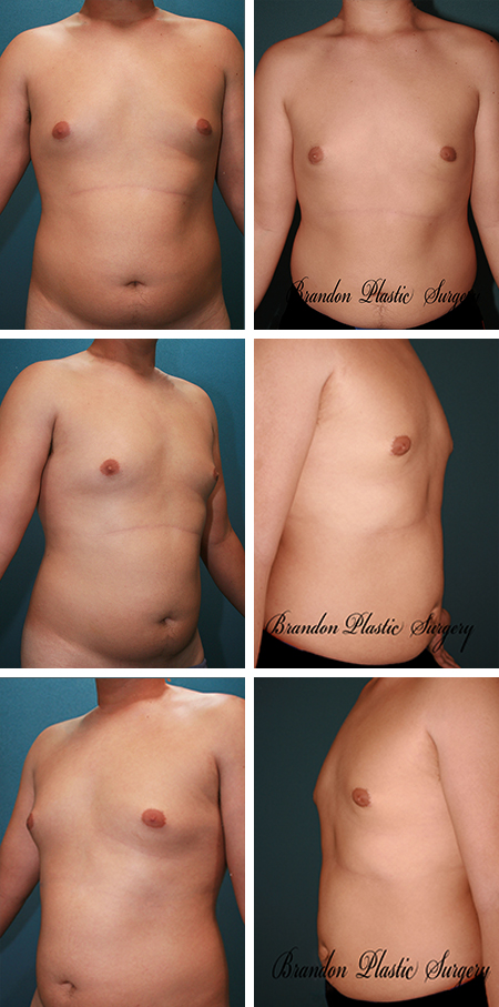 18 y/o Gynecomastia Spring Hill Fl Male Breast Reduction puffy nipple removal and waist Vaser Lipo sculpting