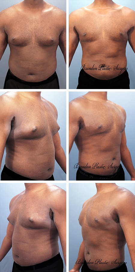 24 y/o Male Breast Reduction Brandon Fl Gynecomastia and chest fullness treated with Vaser Body Lipo sculpting