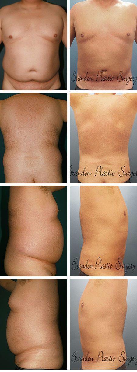 54 y/o Gynecomastia Bradenton Palmetto Fl. Male Breast Reduction with Vaser Liposuction of hips thighs flanks waist. chest and back . The offensive abdominal tire has been totally removed.