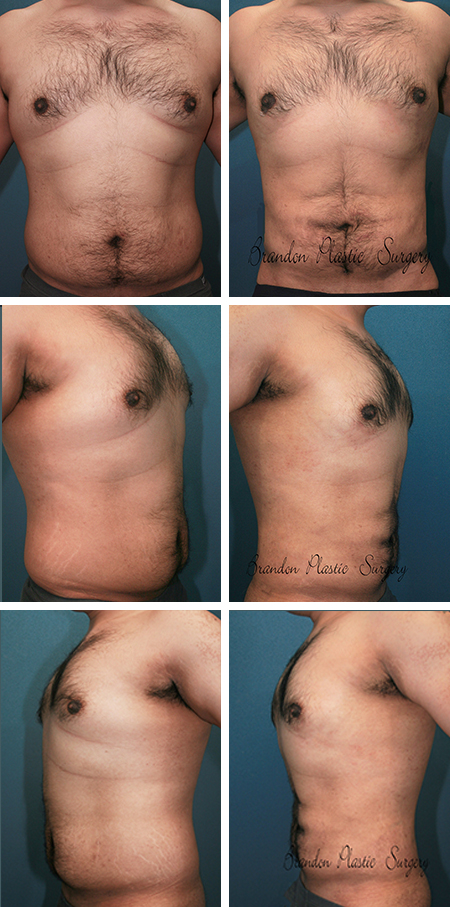 22 y/o Male Breast Reduction Tampa Bay Gynecomastia Surgery and abdominal waist high definition Lipo sculpture with Vaser Ultrasound technique to create an enhanced “ six pack” look