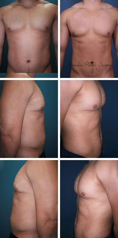 22 y/o Male Liposuction Thonotosassa Temple Terrace Fl Gynecomastia Surgery with puffy nipple flattening and six pack etching of abdominal and waist musculature