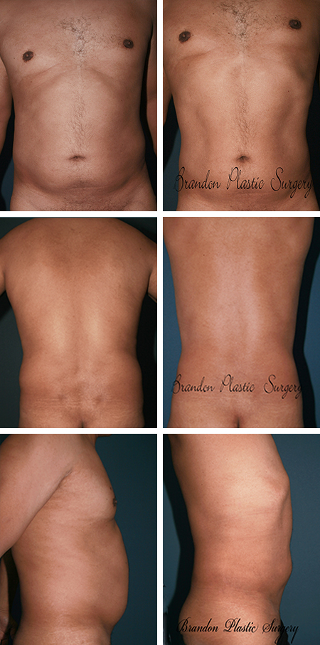 51 y/o Male Liposuction Clearwater Fl Gynecomastia Breast Reduction Surgery and waist and back lipo sculpting with Vaser ultrasonic technique