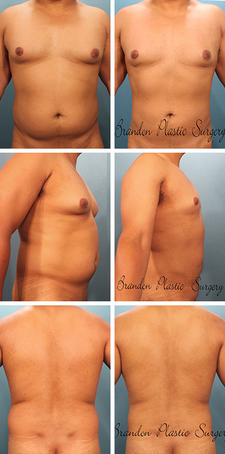 50 y/o Male Breast Reduction Sarasota Fl Gynecomastia Surgery and fat removal from belly flanks and chest utilizing Vaser ultrasonic assisted liposuction