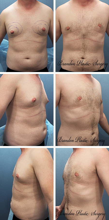 23 y/o Male Breast Reduction Wimauma Ruskin Fl. Gynecomastia and puffy nipple correction with Vaser ultrasonic Lipo Sculpting technique