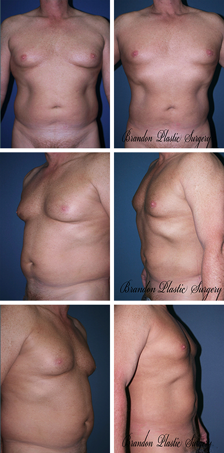 38 y/o Gynecomastia Seminole FL Male Breast Reduction surgery and abdominal Vaser liposuction for a narrowed and more defined waistline