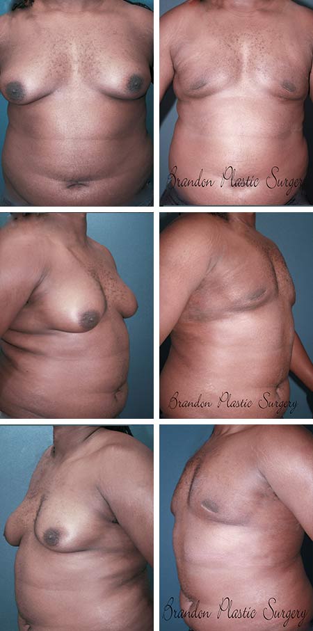 35 y/o Gynecomastia Westchase Fl Male Breast Reduction with Vaser ultrasonic technique to shrink and flatten excess breast skin without the need for skin excision and chest scars