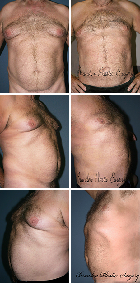 64 y/o Gynecomastia Leesburg The Villages FL Male Breast Reduction and puffy nipple removal with Vaser ultrasonic assisted Lipo sculpting technique
