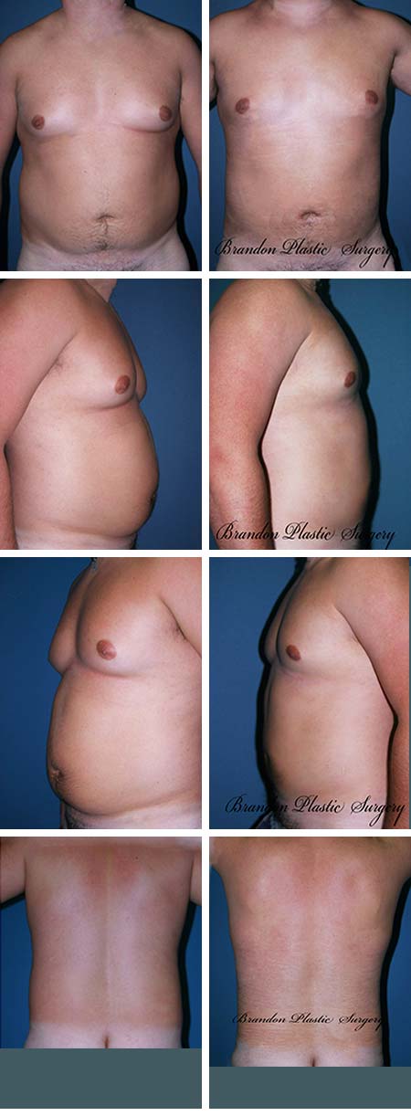 40 y/o Male Breast Reduction Clermont FL Gynecomastia Surgery with lipo sculpting of waist , flanks , hips thighs and back for a more slender and appealing body silhouette