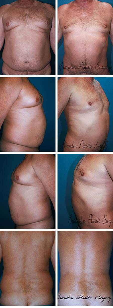 45 y/o Gynecomastia Polk County Florida Male Breast Reduction and Vaser Body Lipo Sculpting to remove the offending abdominal tire fat . The Vaser ultrasonic technique is highly efficient at shrinking and flattening the excess breast skin envelope and minimizing the puffy nipple appearance,