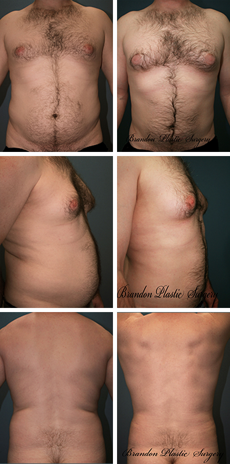 51 y/o Men Liposuction Palm Harbor FL Gynecomastia Male Breast Reduction and circumferential Vaser Lipo sculpting of excess waist .chest back. flank. thigh and hip adiposity .