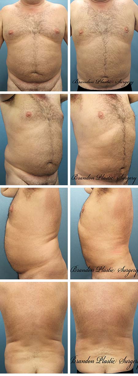 41 y/o Male Liposuction Manatee County Florida Gynecomastia Surgery with 360 degree fat removal of waist , chest . thighs , hips flanks and back for a more slender masculine physique.