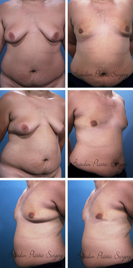 19 y/o Gynecomastia Pinellas County FL Male Breast Reduction with Vaser Ultrasonic Liposuction to contour and flatten marked breast skin redundancy