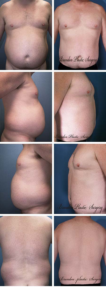 47 y/o Male Liposuction West Central Florida Gynecomastia Male Breast Reduction with ultrasonic Lipo sculpting of chest , waist hips thighs and flanks utilizing Vaser technique