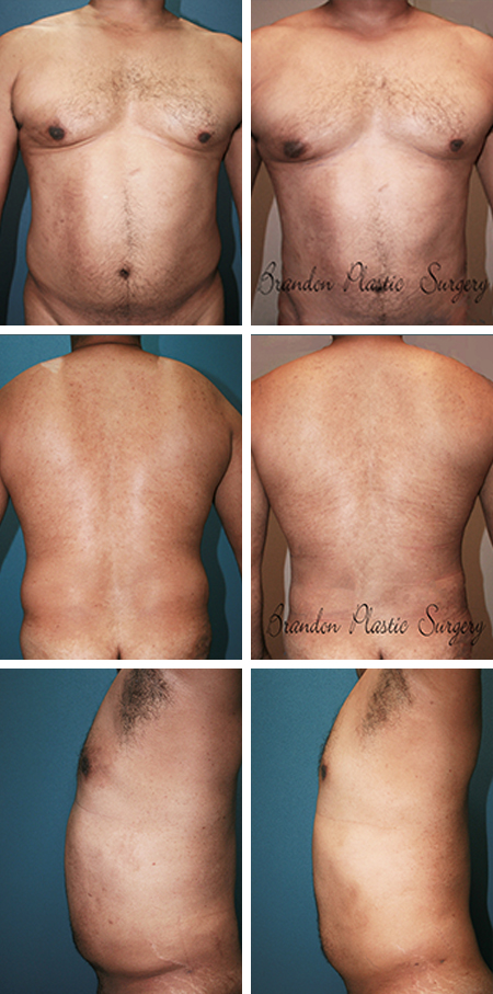 50 y/o Male Breast Reduction Bartow Florida Gynecomastia Surgery with 360 circumferential Vaser Ultrasonic Lipo Sculpting for a contoured and slender body profile