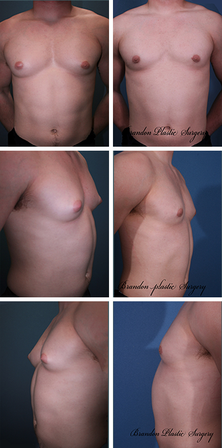 32 Y/o Male Breast Reduction Orlando FL Gynecomastia Surgery with chest and waist Lipo sculpting utilizing Vaser ultrasonic assist.