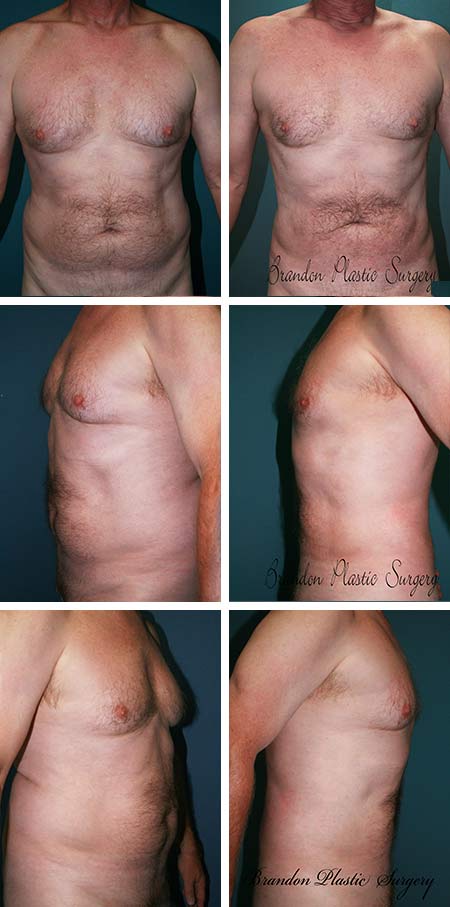 41 y/o Male Liposuction Gulf Coast Florida gynecomastia and abdominal tire removal with ultrasonic assisted Vaser liposuction.