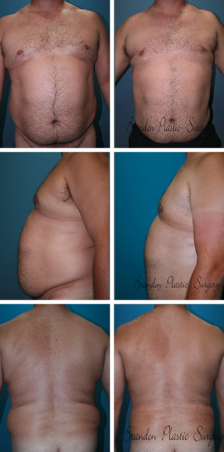 64 y/o Male Liposuction Largo Fl Gynecomastia Male Breast Reduction with contouring of the external fat of chest, waist and flanks . Note intra-abdominal belly fat and abdominal wall distension cannot adequately be addressed with Liposuction alone.