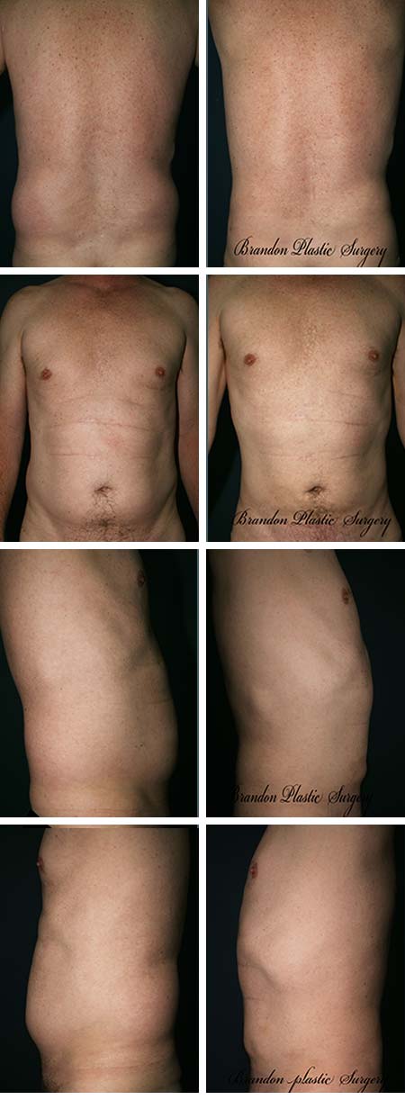 35 y/o Male Liposuction Haines City Fl Gynecomastia and waist sculpting for a sleeker body outline.