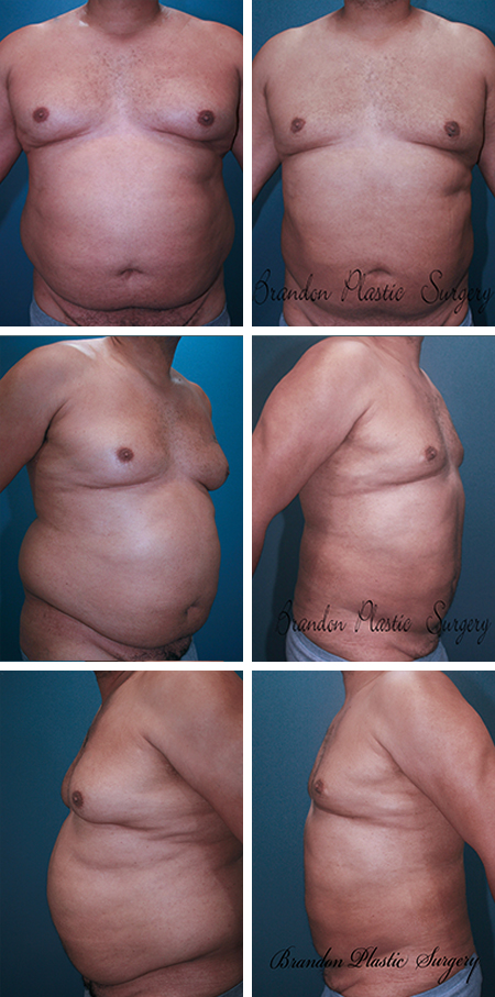 54 y/o Male Breast Reduction Lutz FL Gynecomastia Surgery with circumferential 360 upper body fat removal