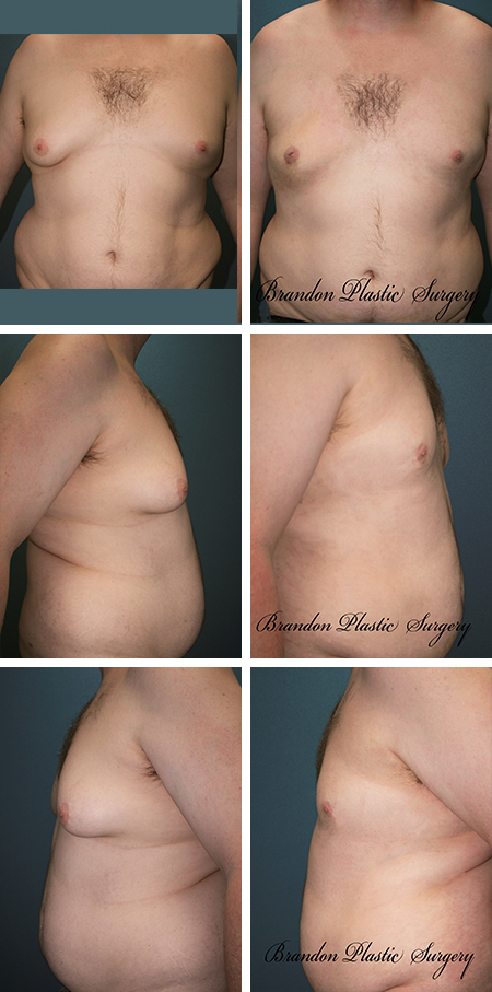 32 y/o Gynecomastia Kissimmee FL. Male Breast Reduction with Vaser Ultrasonic Lipo Sculpting and tightening of breast skin envelope