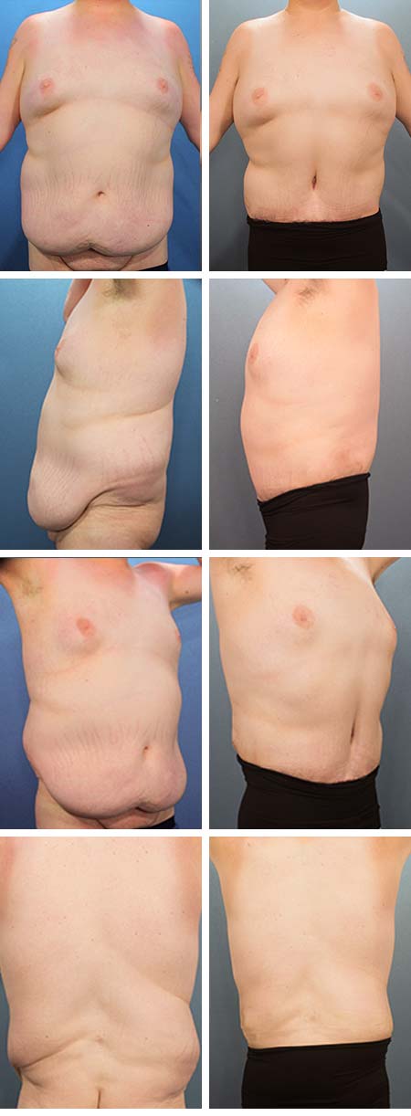 40 y/o Male Tummy Tuck Brandon Riverview FL breast reduction abdominal panniculus removal from prior weight loss.