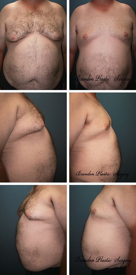 58 y/o Male Breast Reduction Celebration FL Gynecomastia Surgery with puffy nipple elimination and correction of excessive loose breast skin with Vaser Ultrasonic Lipo Sculpting .