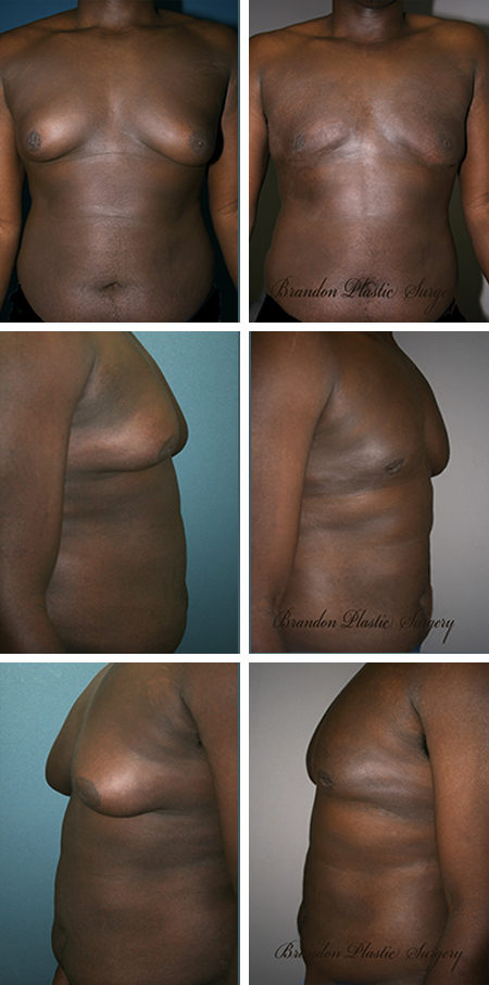 35 y/o Male Breast Reduction Hardee County FL. Gynecomastia with fat , gland and skin reduction using Vaser assisted Lipo Sculpting to melt and shrink the redundant tissues.