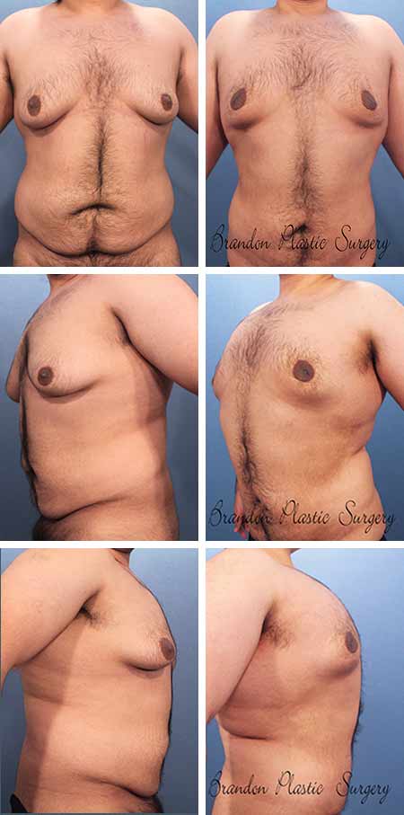 21 y/o Gynecomastia Mulberry Florida Male Breast Reduction with Vaser ultrasonic assisted skin retraction to avoid Tummy Tuck and Mastopexy type breast scars.