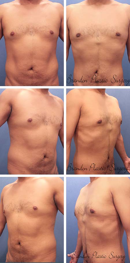 39 y/o Male Liposuction Tampa Florida Vaser high definition body sculpting to accentuate the abdominal musculature and obliterate the protruding hip rolls and love handles .