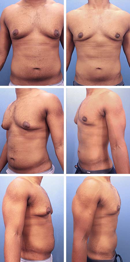 37 y/o Gynecomastia Winter Haven Fl Liposuction Male Body Contouring utilizing Vaser ultrasonic Lipo sculpting to “melt” resistant chest and abdominal fat and allow skin retraction along natural muscle body contours