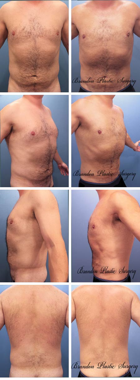 45 y/o Male Liposuction Plant City Florida Vaser Body Sculpting of persistent flank and waist fat deposits highly resistant to diet and exercise.