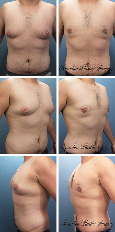 24 y/o Gynecomastia Wesley Chapel Fl. Male Breast Reduction with flattening and smoothing of the breast and nipple redundancies by Vaser Ultrasonic technique ,