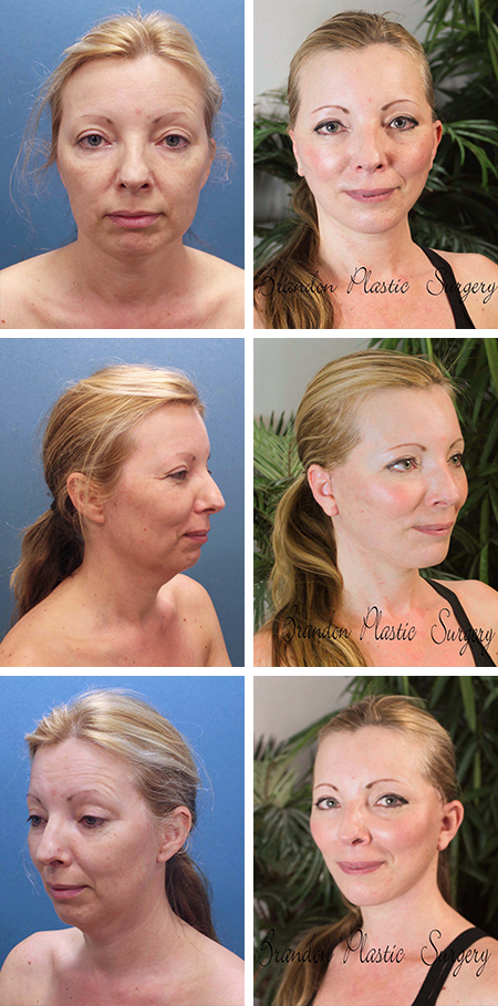 facelift before and after brandon fl