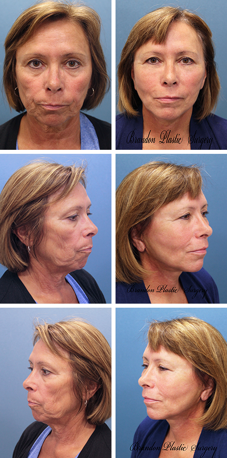 facelift before and after brandon fl