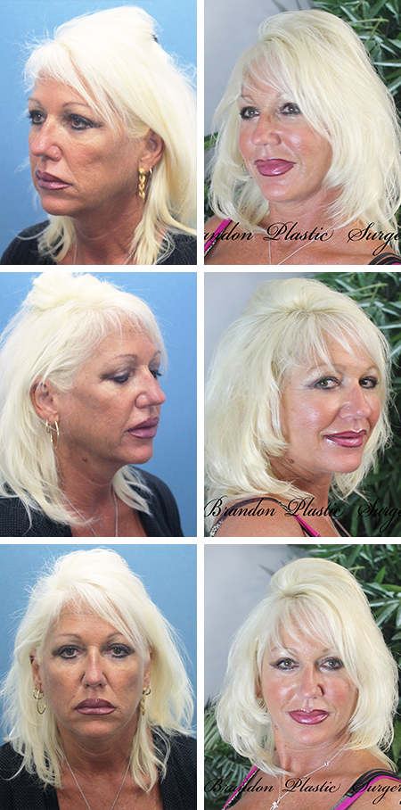 facelift before and after brandon fl