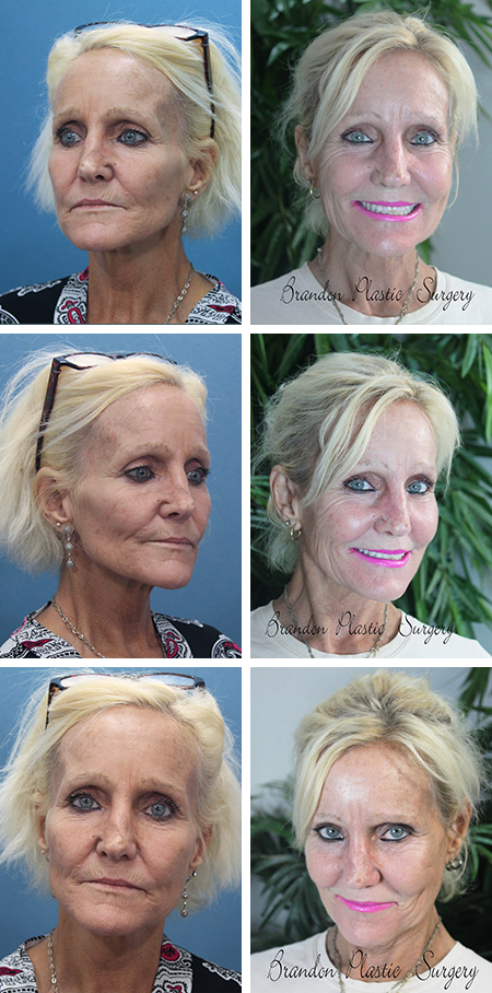facelift before and after brandon fl