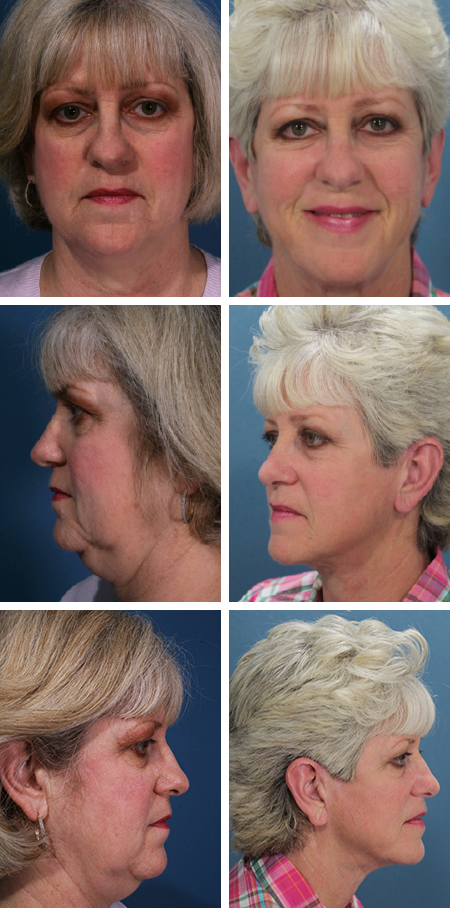 facelift before and after brandon fl