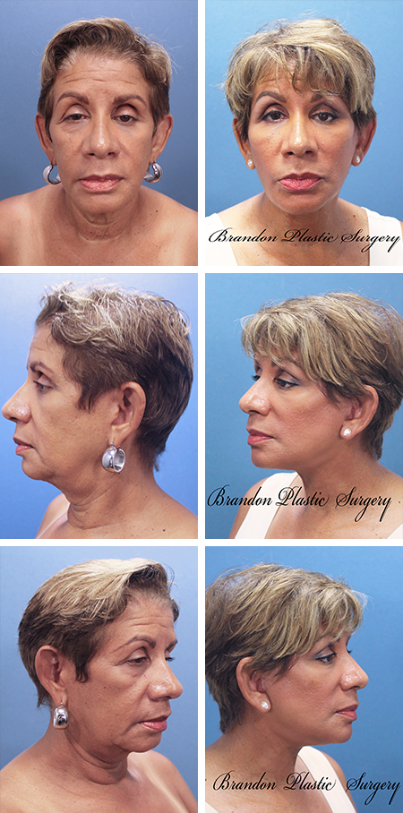 facelift before and after brandon fl