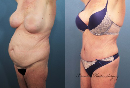 umbilical breast augmentation in tampa Umbilical breast augmentation in tampa
