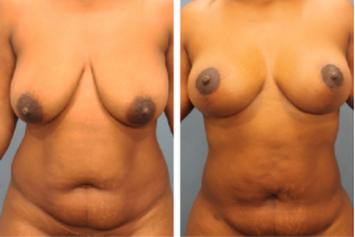Maintaining Your Breast Lift Results
